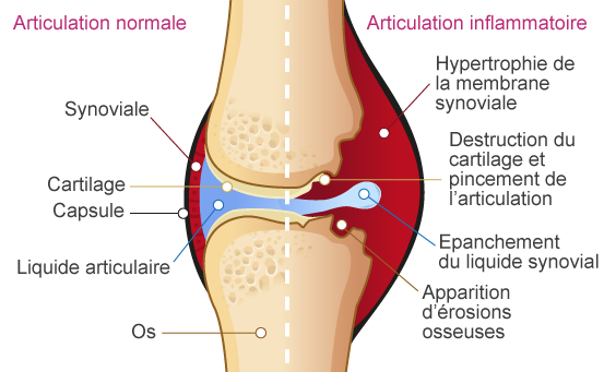 schéma articulation inflammatoire Polyarthrite rhumatoïque