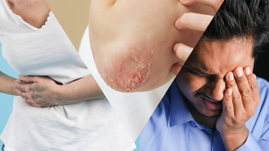 spondyloarthrite visuel 