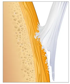 Schéma enthèse inflammatoire
