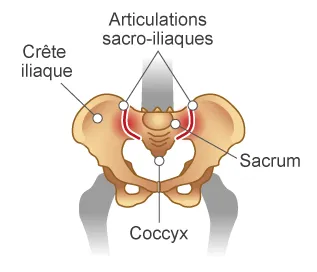 spondyloarthrite visuel bassin