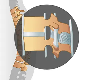 SPA insertion ligaments