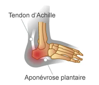spondyloarthrite visuel talon