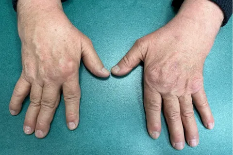 Image de main avec polyarthrite rhumatoïque